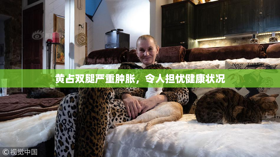 黄占双腿严重肿胀，令人担忧健康状况