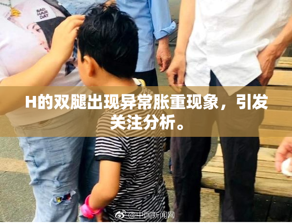 H的双腿出现异常胀重现象，引发关注分析。